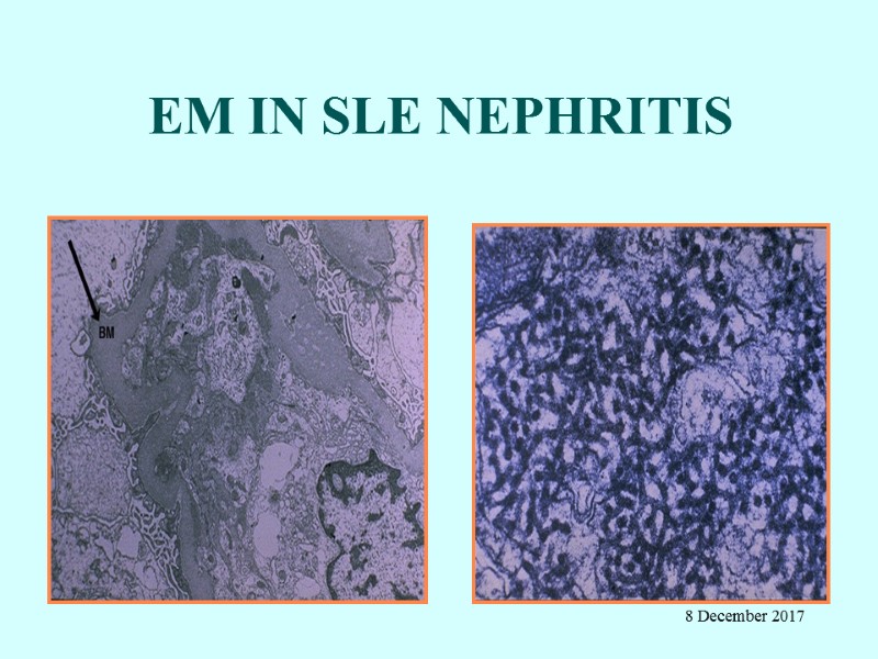 EM IN SLE NEPHRITIS 8 December 2017